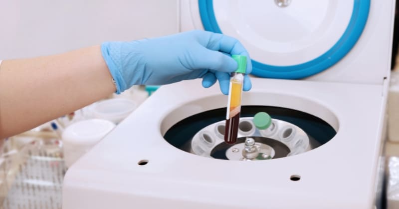 טיפול PRP/PRF – חידוש ביולוגי לגוף